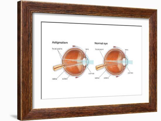 Scleral Buckle. Eye, Ophthalmology, Health and Disease-Encyclopaedia Britannica-Framed Art Print