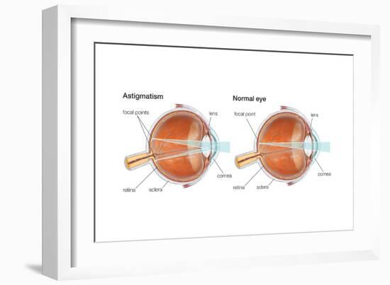 Scleral Buckle. Eye, Ophthalmology, Health and Disease-Encyclopaedia Britannica-Framed Art Print