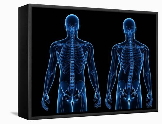 Scoliosis of the Spine, Artwork-SCIEPRO-Framed Premier Image Canvas