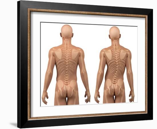 Scoliosis of the Spine, Artwork-SCIEPRO-Framed Photographic Print