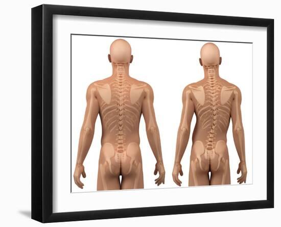 Scoliosis of the Spine, Artwork-SCIEPRO-Framed Photographic Print