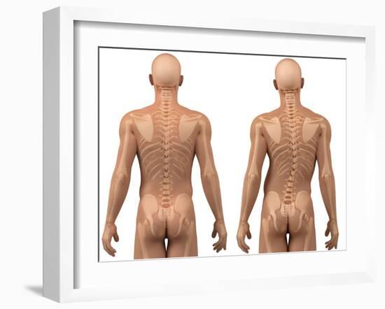 Scoliosis of the Spine, Artwork-SCIEPRO-Framed Photographic Print