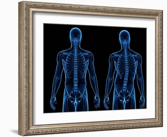 Scoliosis of the Spine, Artwork-SCIEPRO-Framed Photographic Print