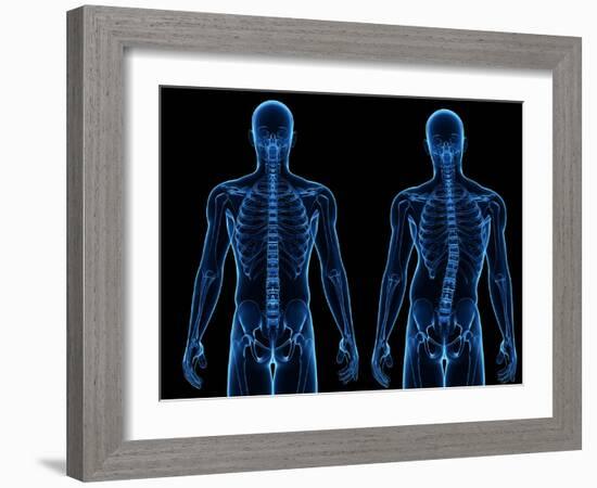 Scoliosis of the Spine, Artwork-SCIEPRO-Framed Photographic Print