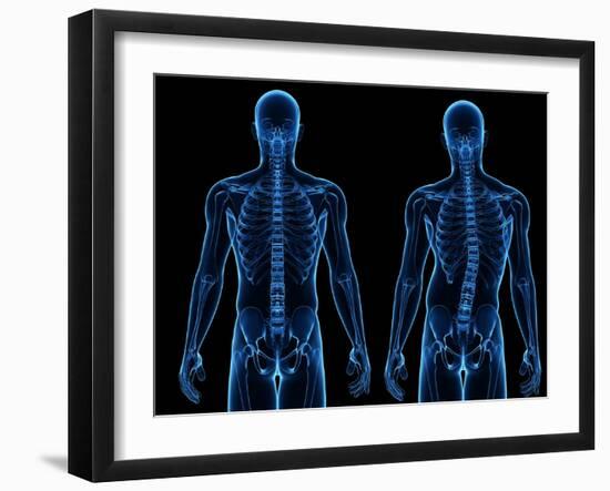 Scoliosis of the Spine, Artwork-SCIEPRO-Framed Photographic Print