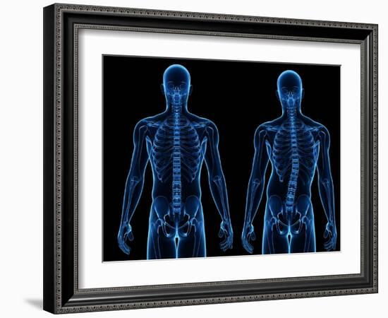 Scoliosis of the Spine, Artwork-SCIEPRO-Framed Photographic Print