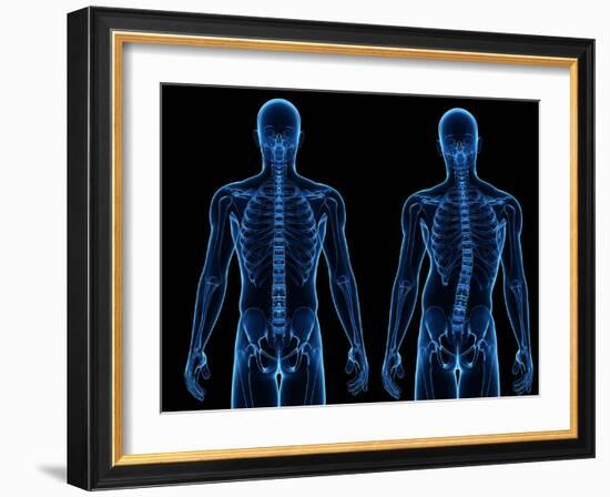 Scoliosis of the Spine, Artwork-SCIEPRO-Framed Photographic Print