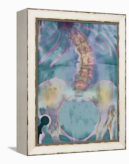 Scoliosis Spine Deformity, X-ray-Science Photo Library-Framed Premier Image Canvas