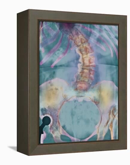 Scoliosis Spine Deformity, X-ray-Science Photo Library-Framed Premier Image Canvas