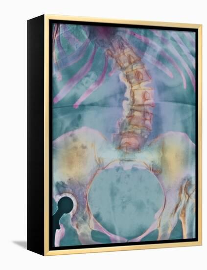 Scoliosis Spine Deformity, X-ray-Science Photo Library-Framed Premier Image Canvas