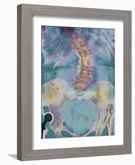 Scoliosis Spine Deformity, X-ray-Science Photo Library-Framed Photographic Print