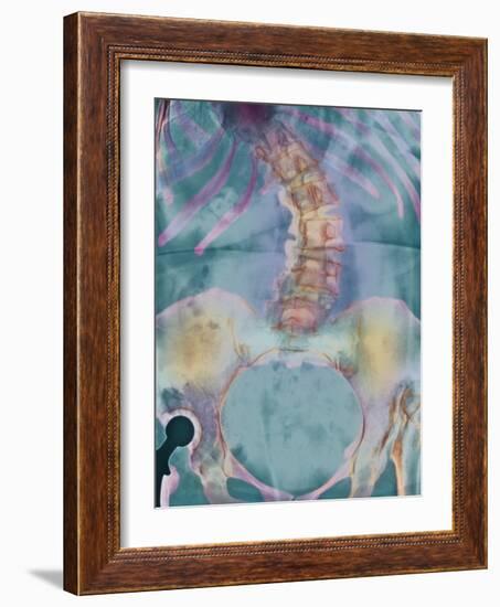 Scoliosis Spine Deformity, X-ray-Science Photo Library-Framed Photographic Print