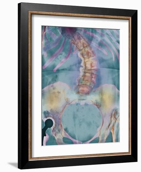 Scoliosis Spine Deformity, X-ray-Science Photo Library-Framed Photographic Print