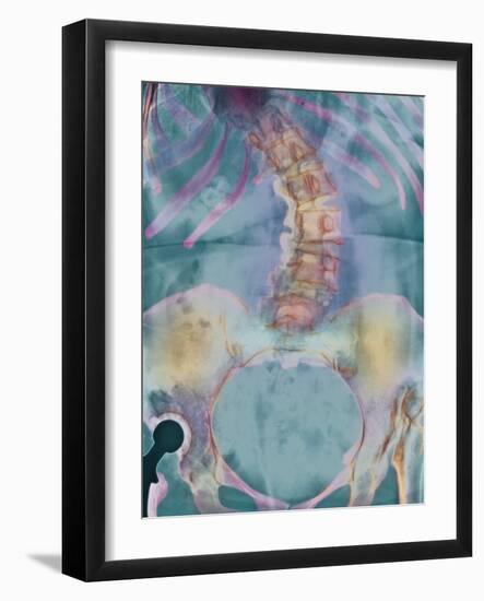 Scoliosis Spine Deformity, X-ray-Science Photo Library-Framed Photographic Print