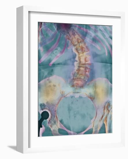 Scoliosis Spine Deformity, X-ray-Science Photo Library-Framed Photographic Print