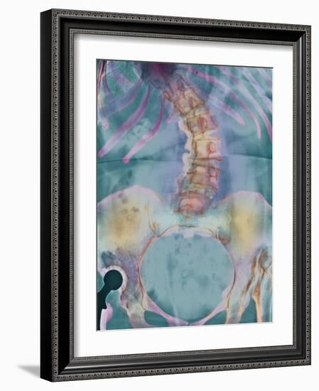 Scoliosis Spine Deformity, X-ray-Science Photo Library-Framed Photographic Print