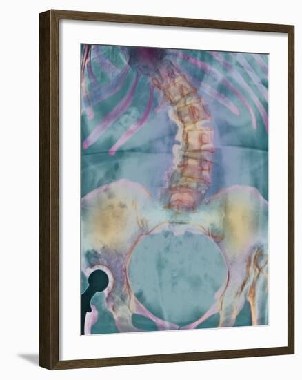 Scoliosis Spine Deformity, X-ray-Science Photo Library-Framed Photographic Print