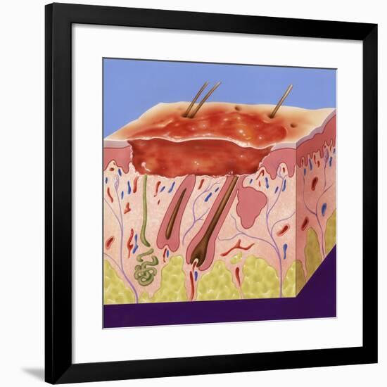 Second-degree Burn, Artwork-John Bavosi-Framed Photographic Print