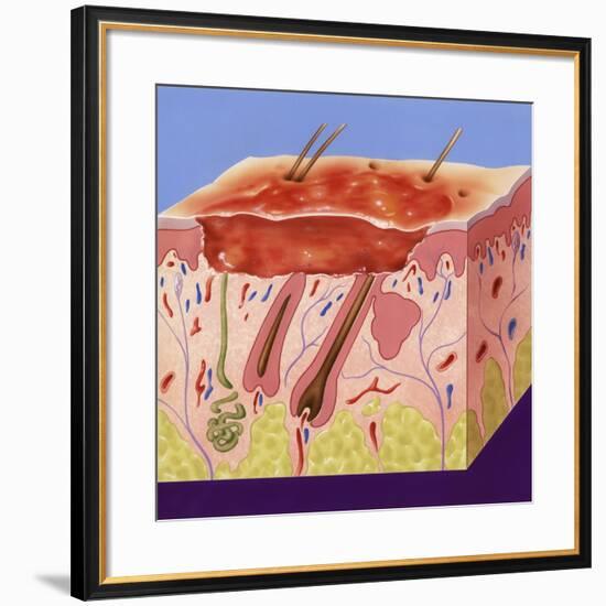 Second-degree Burn, Artwork-John Bavosi-Framed Photographic Print