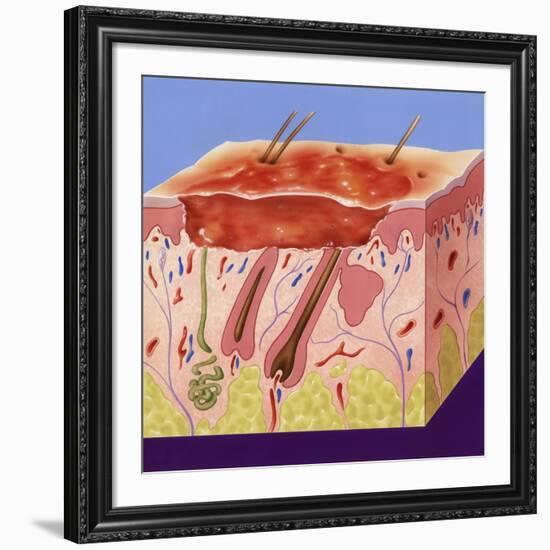 Second-degree Burn, Artwork-John Bavosi-Framed Photographic Print