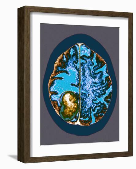 Secondary Brain Cancer, CT Scan-Du Cane Medical-Framed Photographic Print