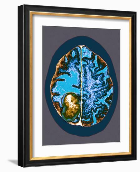 Secondary Brain Cancer, CT Scan-Du Cane Medical-Framed Photographic Print