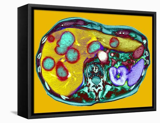 Secondary Liver Cancer, CT Scan-Du Cane Medical-Framed Premier Image Canvas