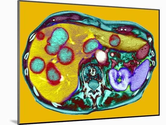 Secondary Liver Cancer, CT Scan-Du Cane Medical-Mounted Photographic Print