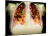 Secondary Lung Cancers, X-ray-Du Cane Medical-Mounted Photographic Print