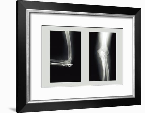 Shattered Elbow Repair-null-Framed Art Print