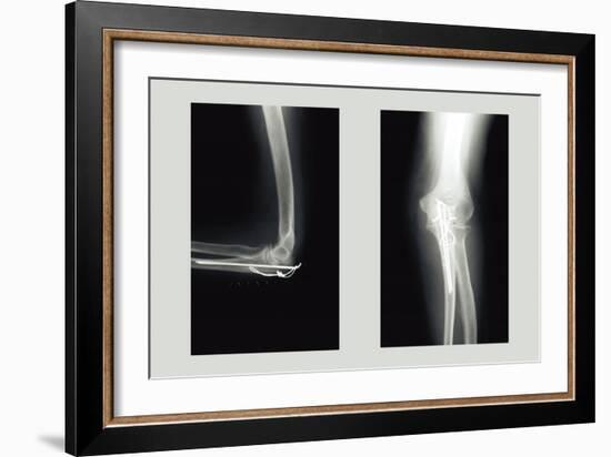 Shattered Elbow Repair-null-Framed Art Print