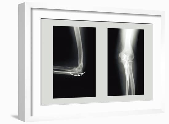 Shattered Elbow Repair-null-Framed Art Print