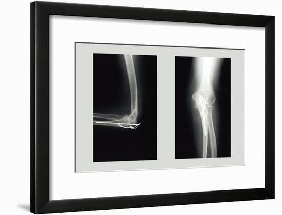 Shattered Elbow Repair-null-Framed Art Print