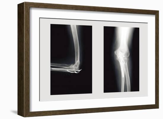 Shattered Elbow Repair-null-Framed Premium Giclee Print