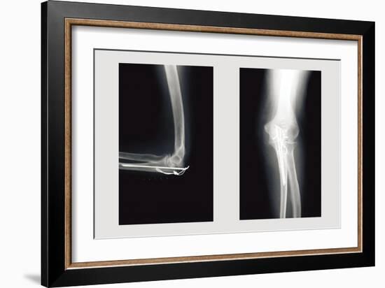 Shattered Elbow Repair-null-Framed Premium Giclee Print