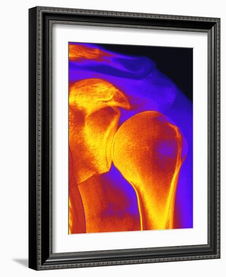 Shoulder Joint X-ray-PASIEKA-Framed Photographic Print