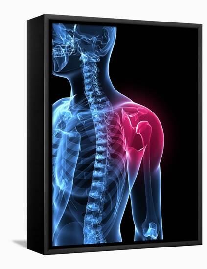 Shoulder Pain, Conceptual Artwork-SCIEPRO-Framed Premier Image Canvas