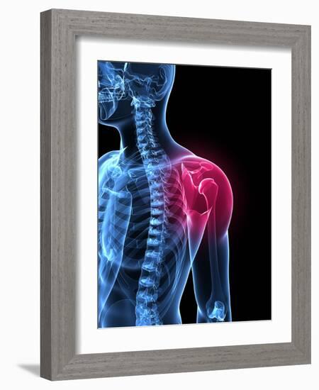 Shoulder Pain, Conceptual Artwork-SCIEPRO-Framed Photographic Print