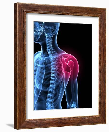 Shoulder Pain, Conceptual Artwork-SCIEPRO-Framed Photographic Print