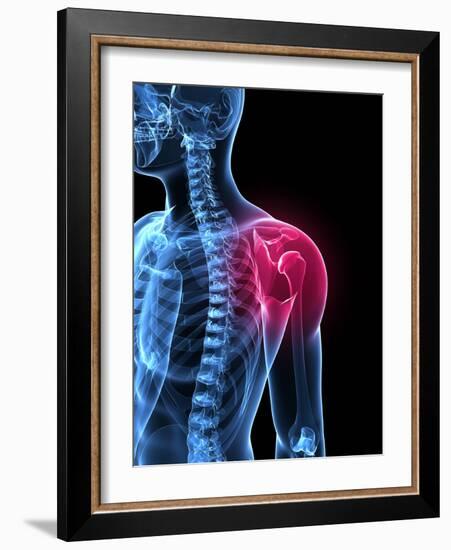 Shoulder Pain, Conceptual Artwork-SCIEPRO-Framed Photographic Print