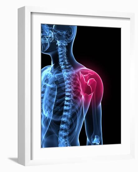 Shoulder Pain, Conceptual Artwork-SCIEPRO-Framed Photographic Print