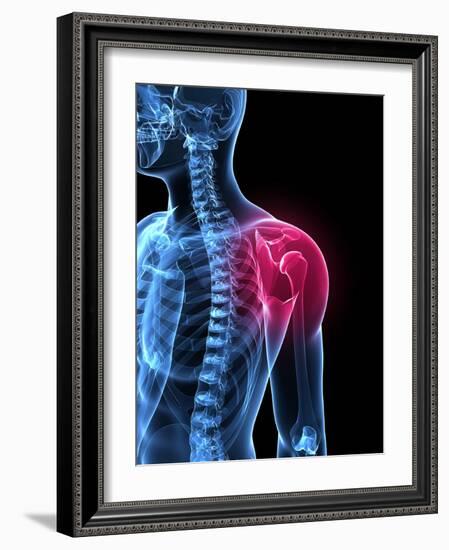 Shoulder Pain, Conceptual Artwork-SCIEPRO-Framed Photographic Print