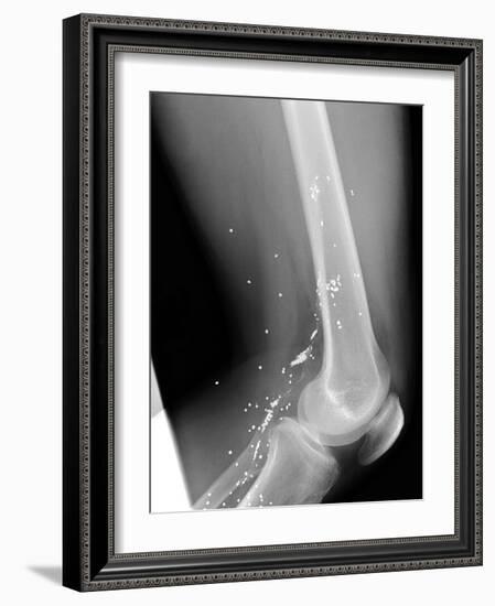 Shrapnel Injury, X-ray-Du Cane Medical-Framed Photographic Print