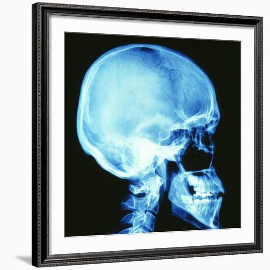 Skull X-ray-PASIEKA-Framed Photographic Print