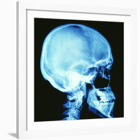 Skull X-ray-PASIEKA-Framed Photographic Print