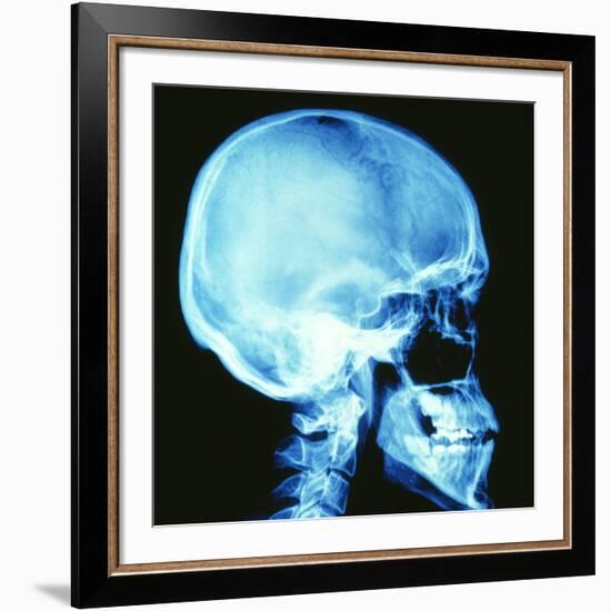 Skull X-ray-PASIEKA-Framed Photographic Print