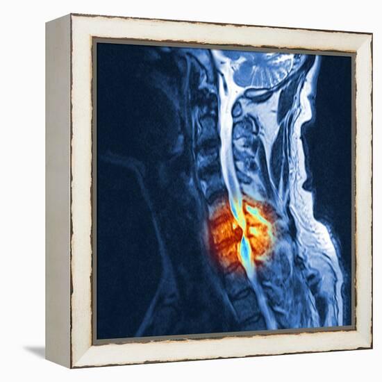 Slipped Disc, MRI Scan-PASIEKA-Framed Premier Image Canvas