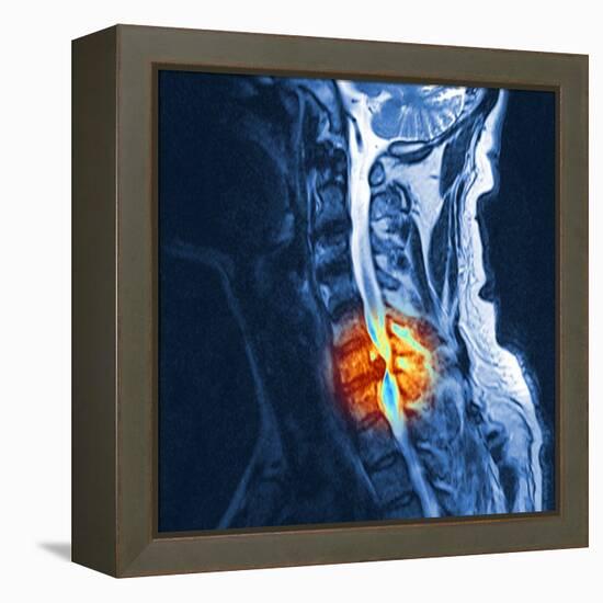 Slipped Disc, MRI Scan-PASIEKA-Framed Premier Image Canvas