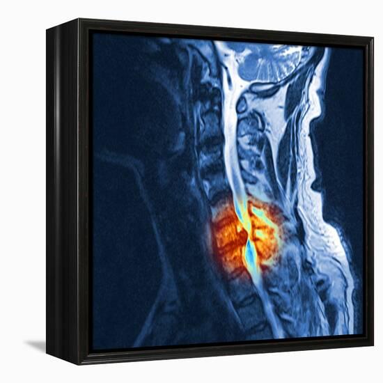 Slipped Disc, MRI Scan-PASIEKA-Framed Premier Image Canvas