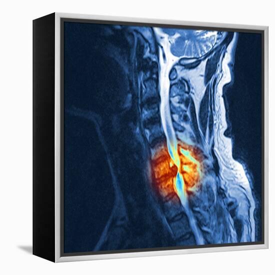 Slipped Disc, MRI Scan-PASIEKA-Framed Premier Image Canvas